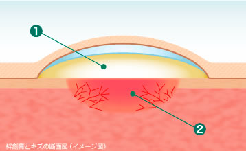 絆創膏とキズの断面図（イメージ図）